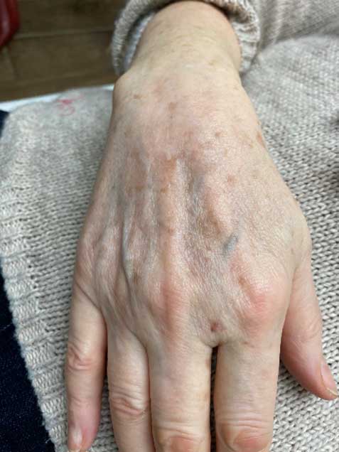 Avant traitement, taches brunes nombreuses du dos des mains