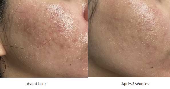 Avant / après le traitement Fraxel contre les cicatrices d'acné à Paris chez le dr Molinari