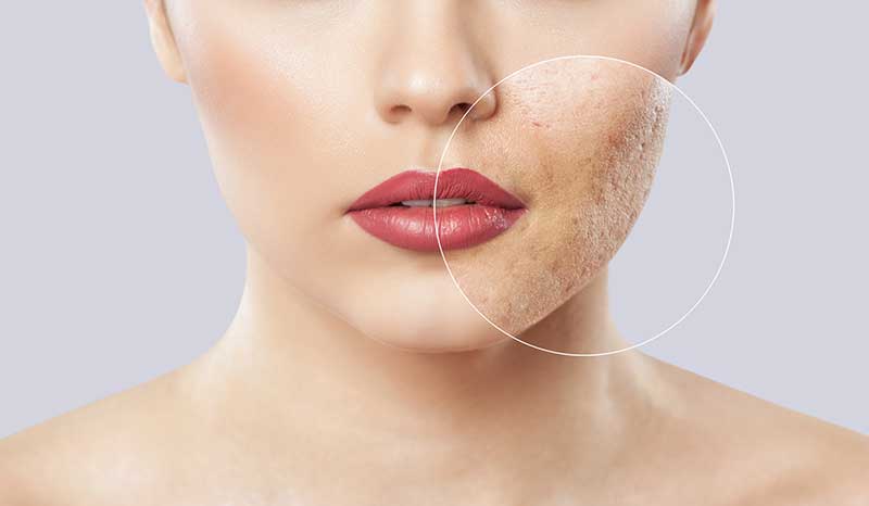 Traitement Fraxel contre les cicatrices d'acné à Paris