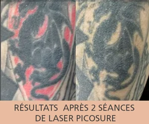 Avant et après un détatouage au laser Picosure à Pairs