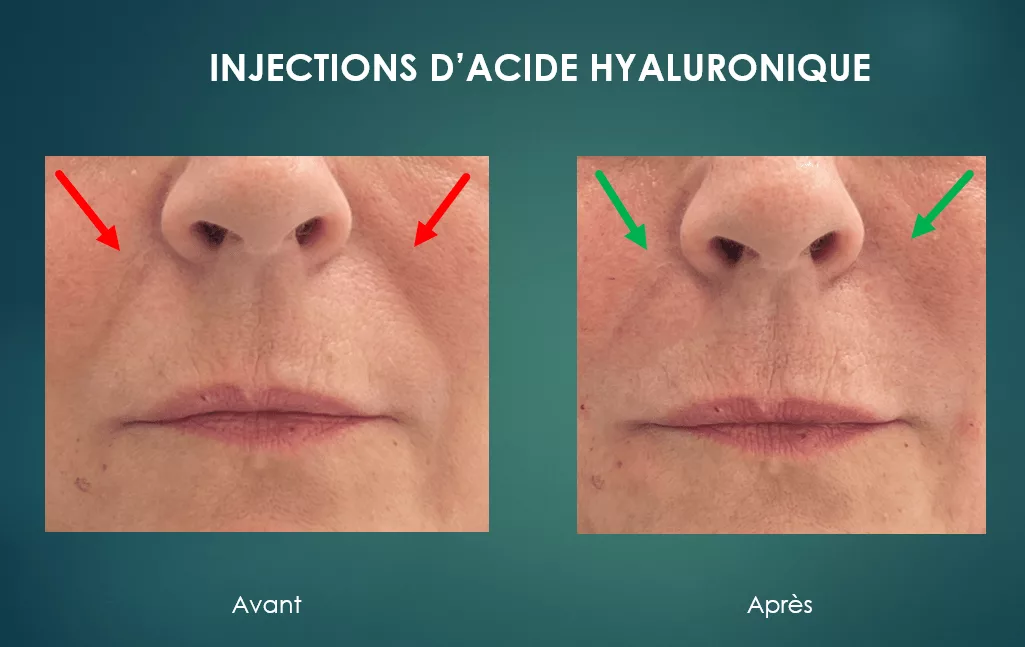 illustration injections d'acide hyaluronique par le docteur Molinari à Paris 7