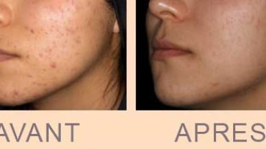 Avant / après traitement laser AviClear contre l'acné à Paris chez le dr Molinari