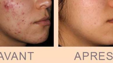 Avant / après traitements laser AviClear contre l'acné à Paris chez le dr Molinari