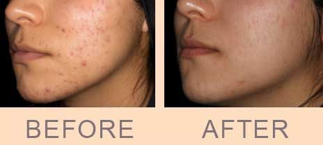 Before / after acne treatment in Paris