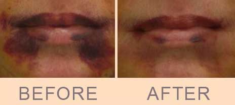 Couperose treatment in Paris by Dr Molinari