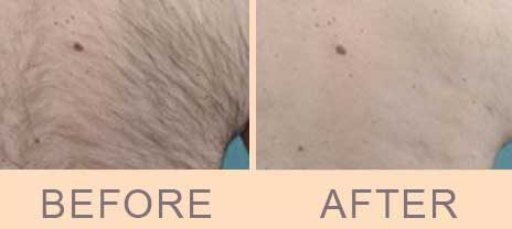 Laser Hair removal - Before / After - Dr Molinari in Paris